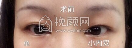 深圳美莱医疗美容医院韩式切开重睑,陈磊医生