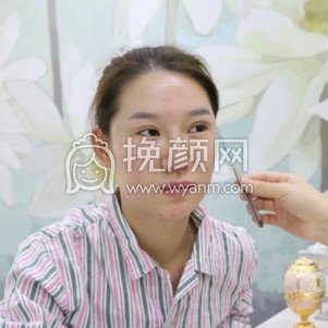 上海华山医院做的双眼皮,163天的分享图片