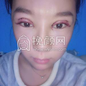 上海华山医院做的双眼皮,163天的分享图片