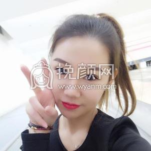 上海华山医院做的双眼皮,163天的分享图片