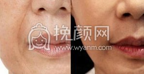 如何去掉脸上的皱纹?注射玻尿酸除皱的优点