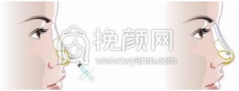 玻尿酸隆鼻打三次会长期吗?