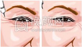 注射BOTOX祛除表情纹果会反弹吗?