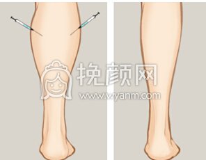 怎么才能拥有纤细的小腿?注射瘦腿