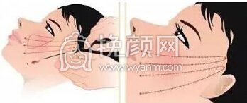埋线提升埋线提升多少钱?