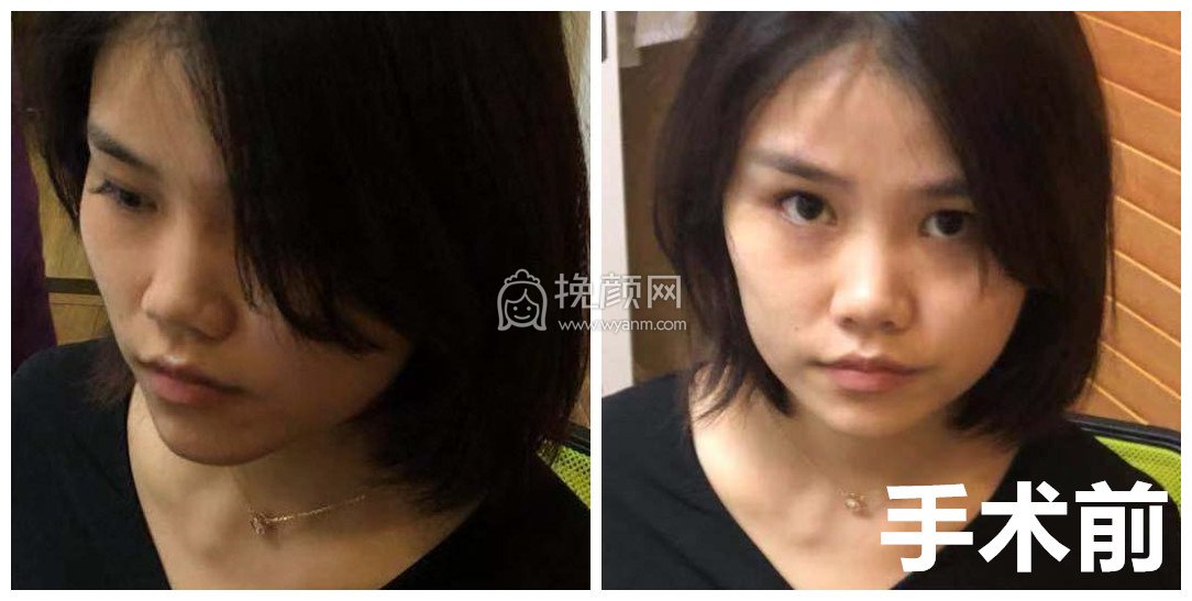 深圳隆鼻:米兰柏羽王志东怎么样?附案例