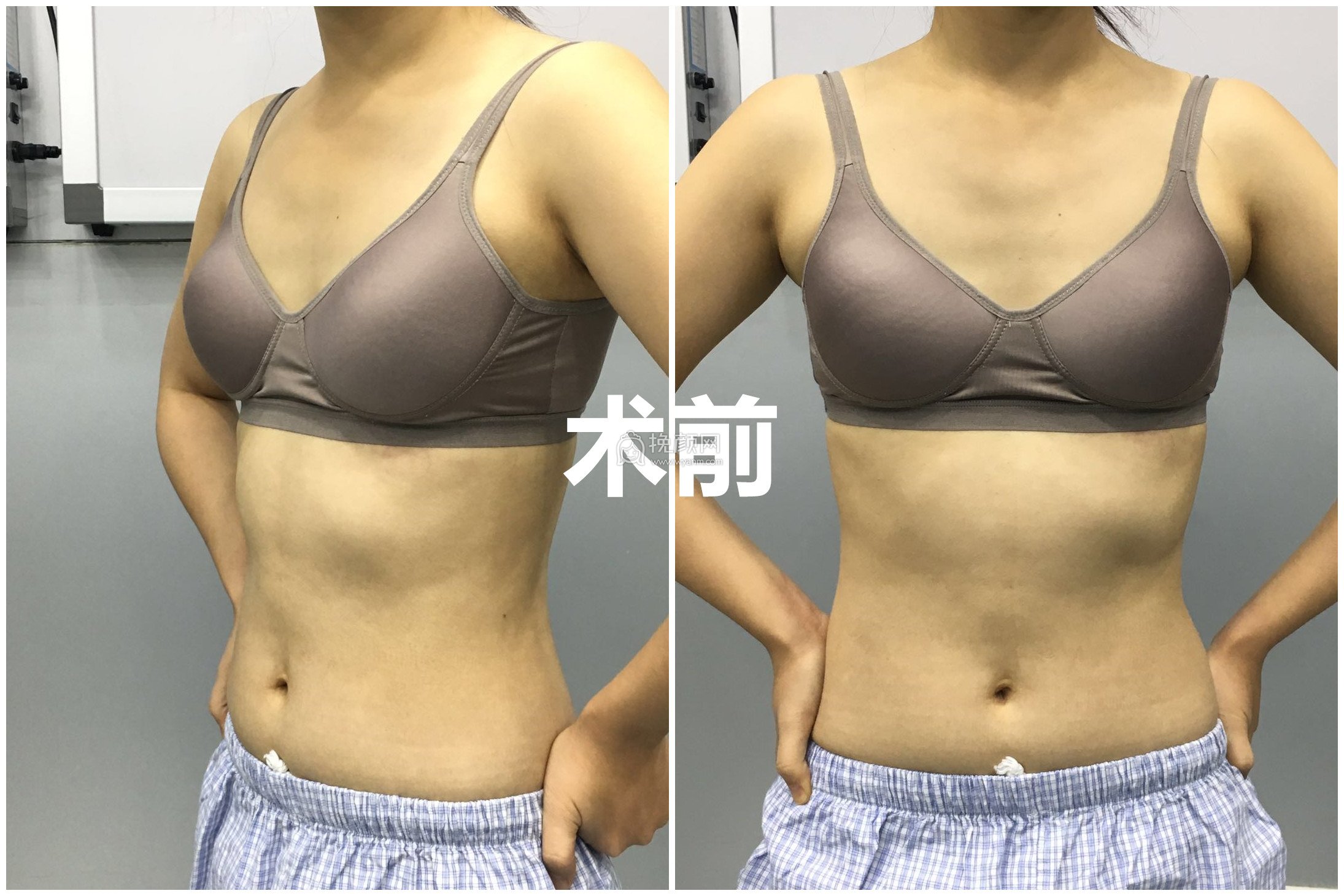 深圳隆胸：鹏爱医疗美容医院蔡国威介绍 附案例