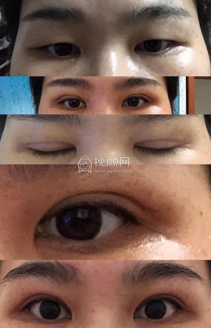 深圳双眼皮:江南春天医疗美容医院李钢案例!