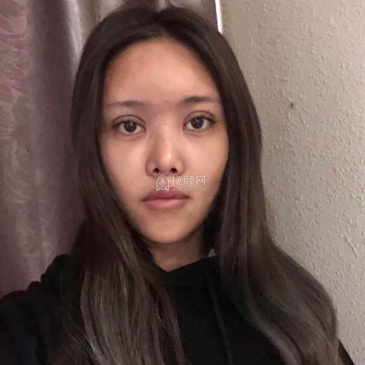 深圳芝华医疗怎么样?高焱隆鼻真实案例!