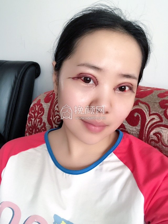 北京双眼皮:中西医结合合陈晓芳好吗?案例!