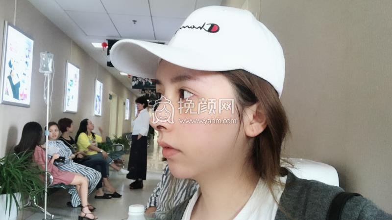 深圳隆鼻修复:晨曦医疗朱春艳好吗?真实案例