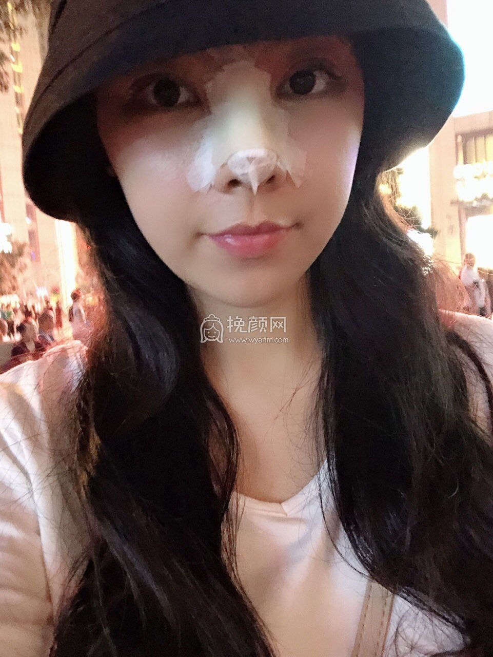 深圳妍熙陈桂飞隆鼻怎么样?真实案例