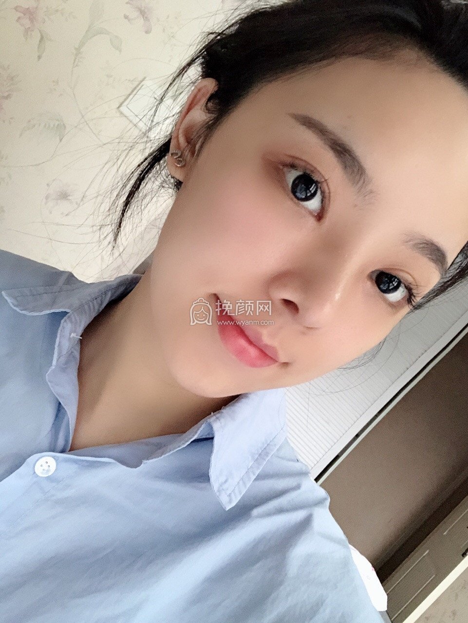 宁波隆鼻:艺星彭鑫怎么样?真实案例!