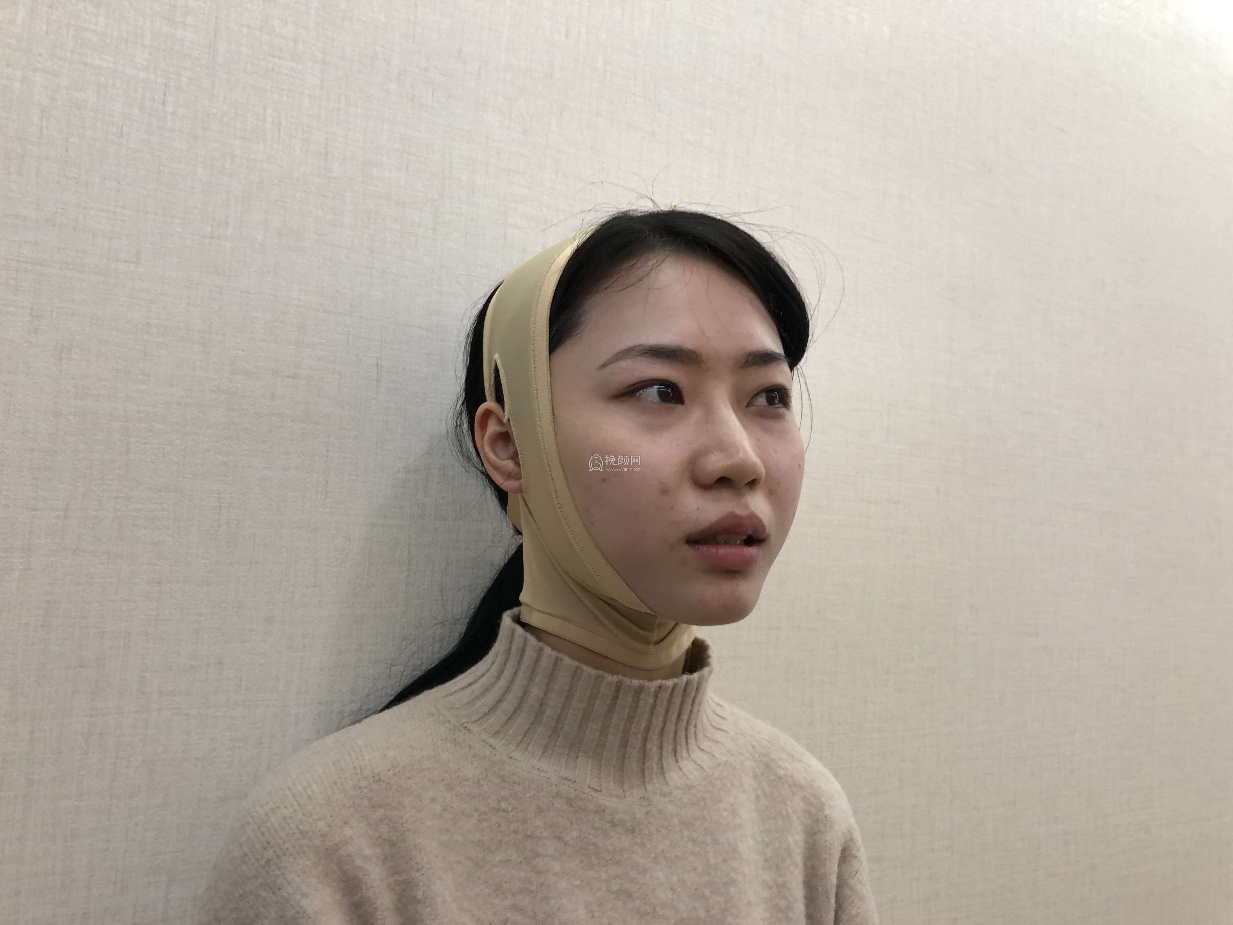 重庆面部吸脂:江北瑞俪胡小义怎么样?案例!