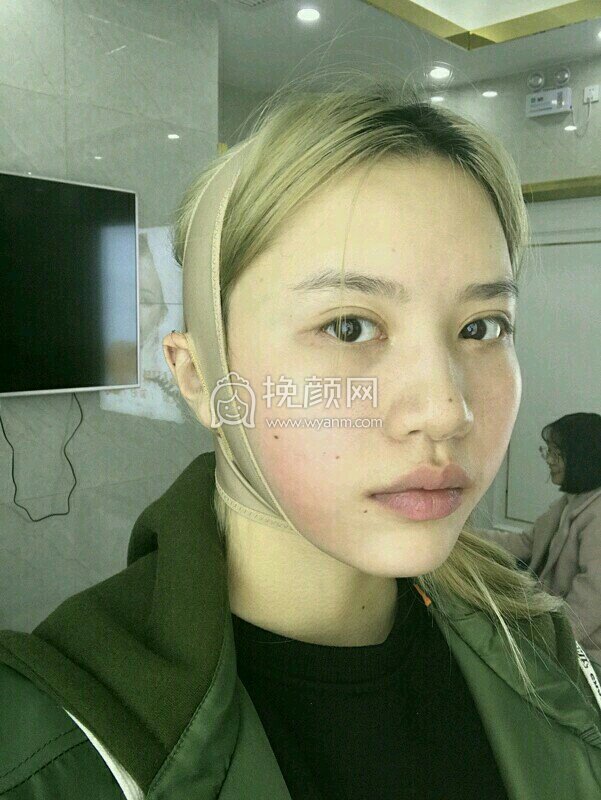 武汉伊美馨桂亮面部吸脂怎么样?真实案例
