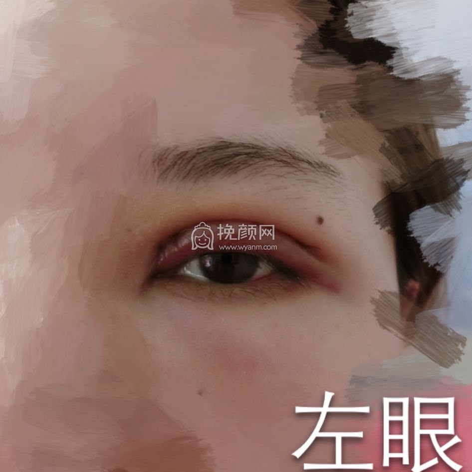 长沙双眼皮:中南大学湘雅三医院陈铁夫案例