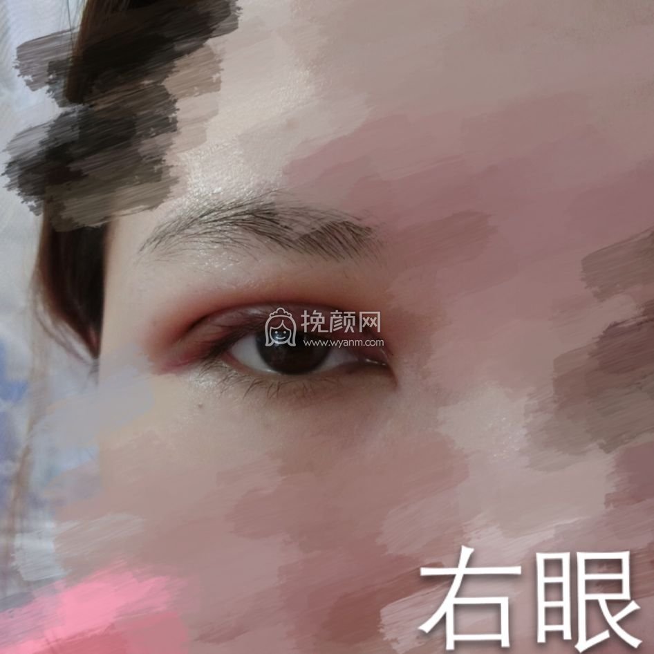 长沙双眼皮:中南大学湘雅三医院陈铁夫案例