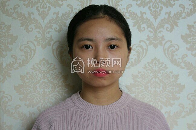 四川军大医学附属医院蒲小兵面部吸脂案例