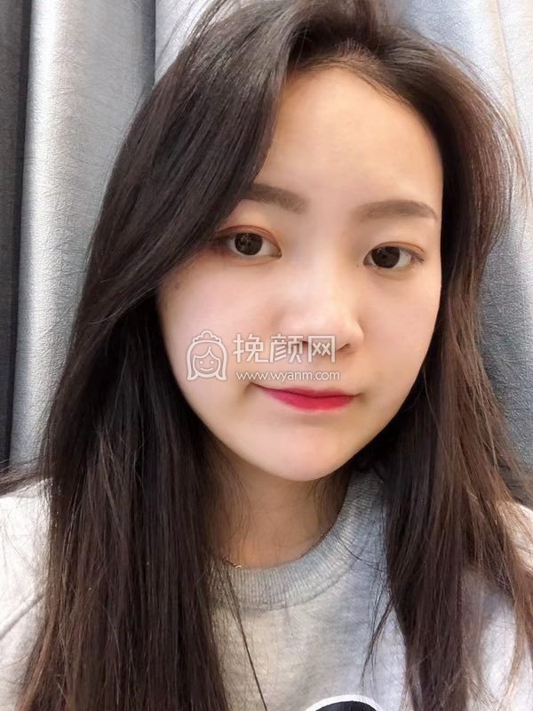 洛阳吸脂:谢景良面部吸脂怎么样?真实案例