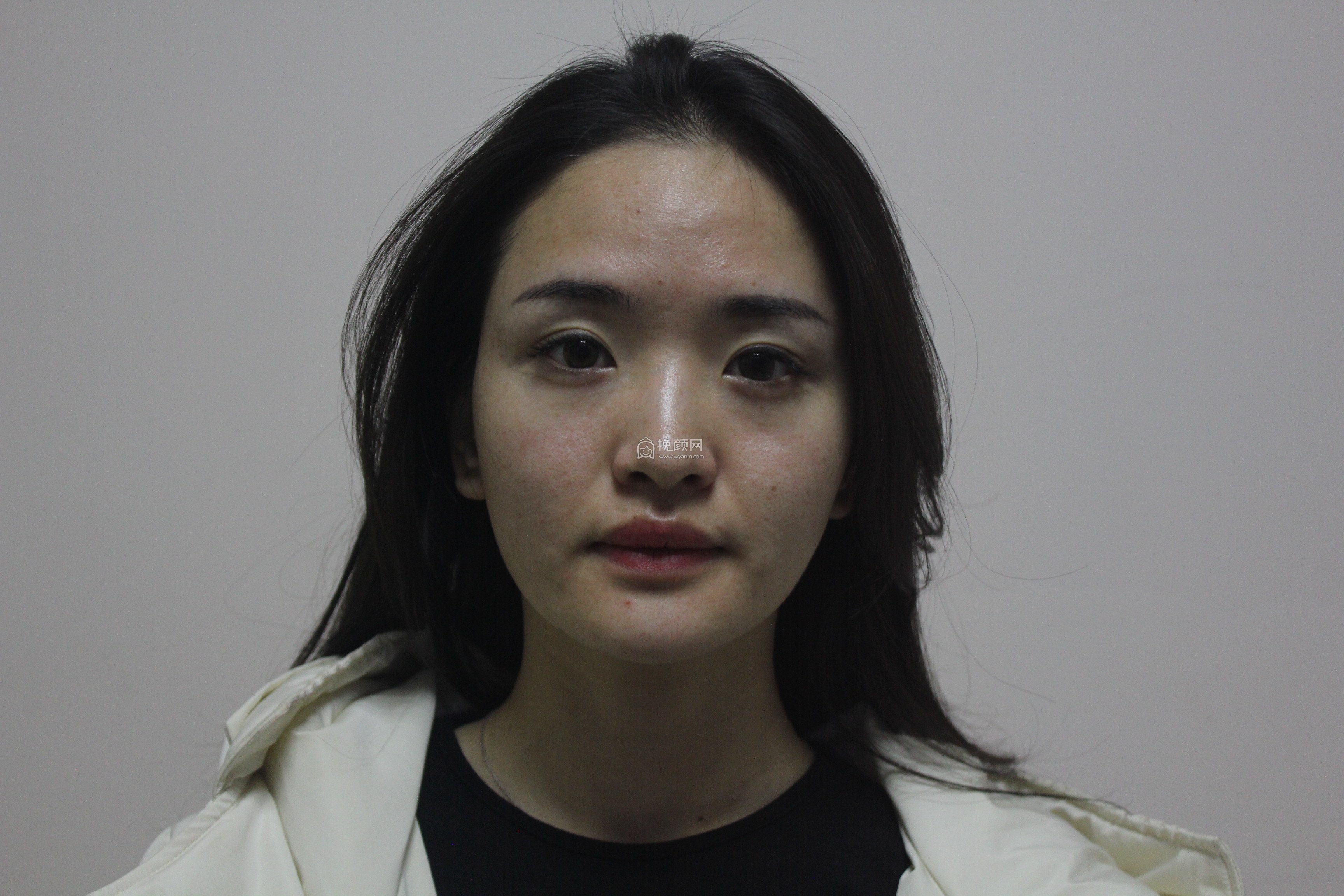 面部自体脂肪填充:成都西区医院毛健清怎么样