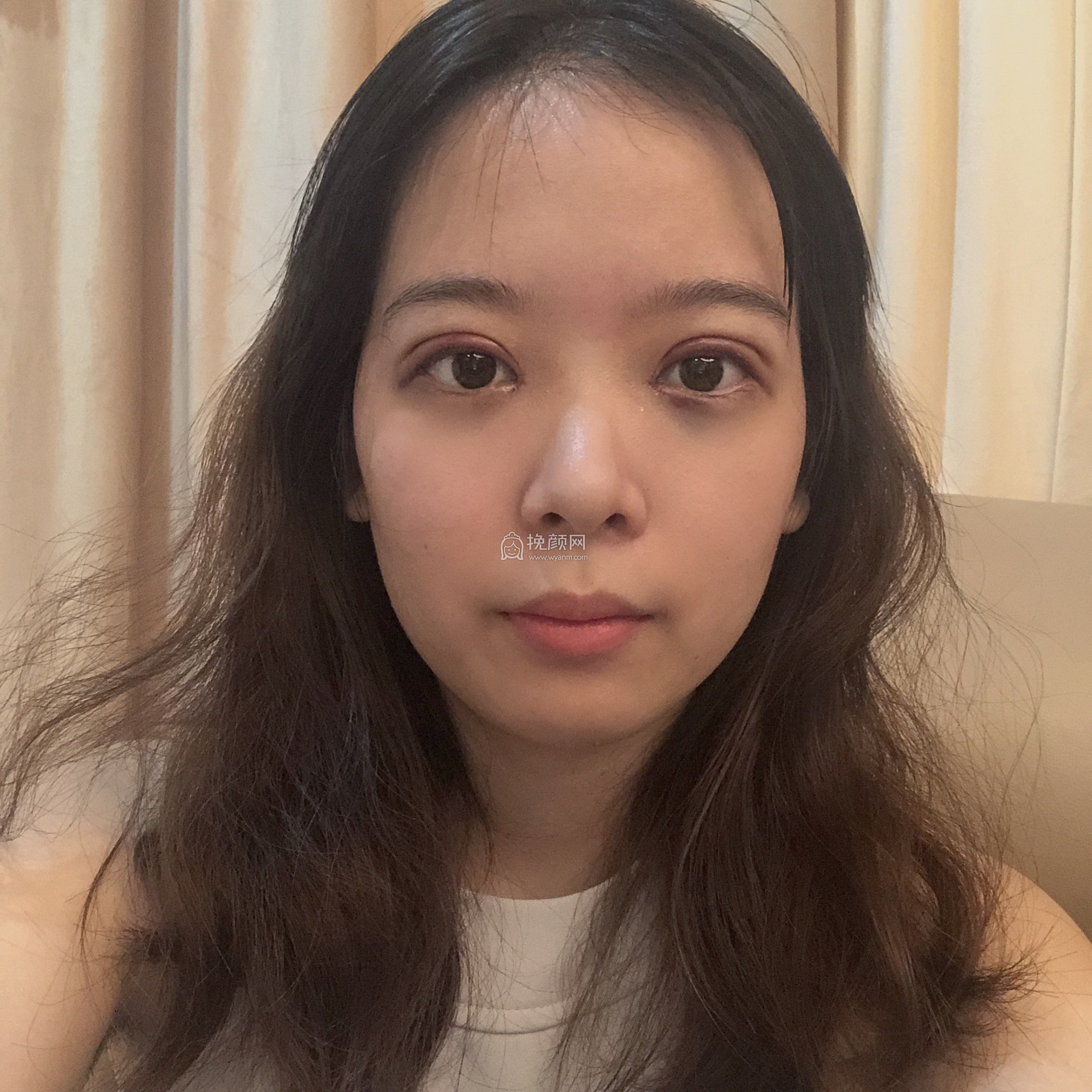 成都安莎贝拉张蕾双眼皮怎么样?真实案例