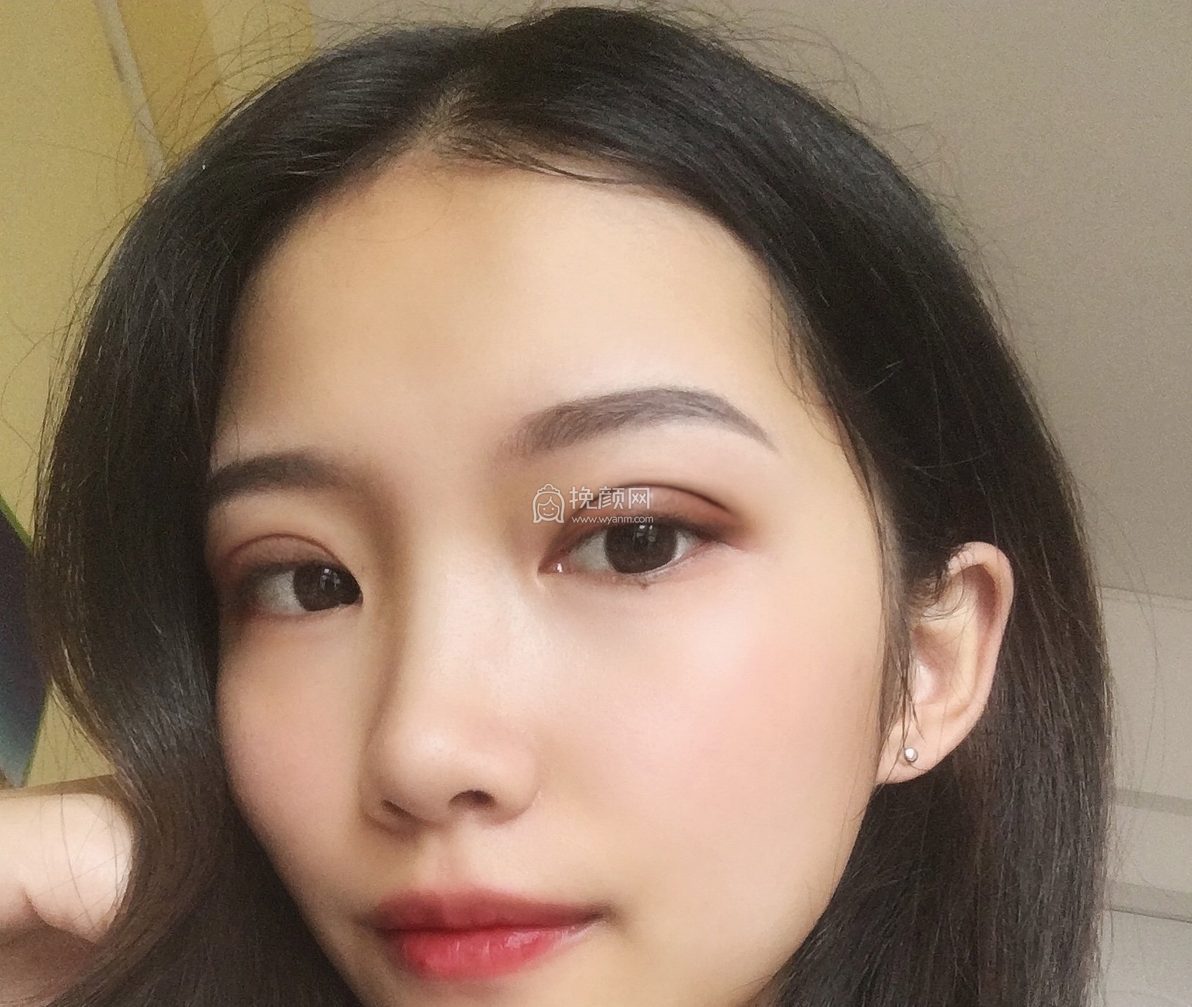 重庆美圣美邦整形邓刚双眼皮怎么样?好吗