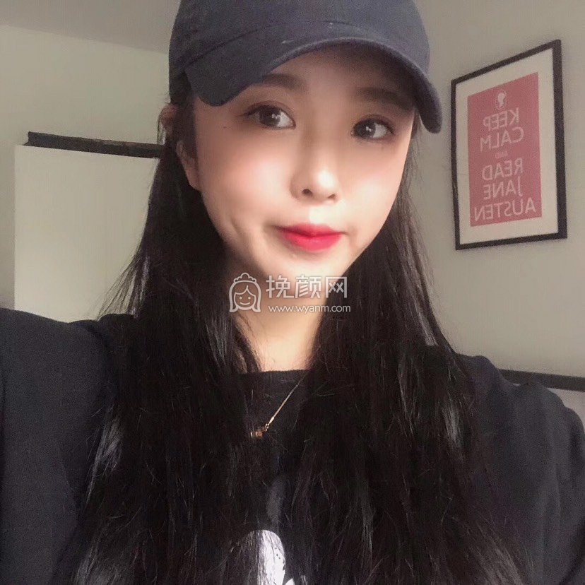 杭州面部吸脂:清吟医疗孙敏捷怎么样?案例