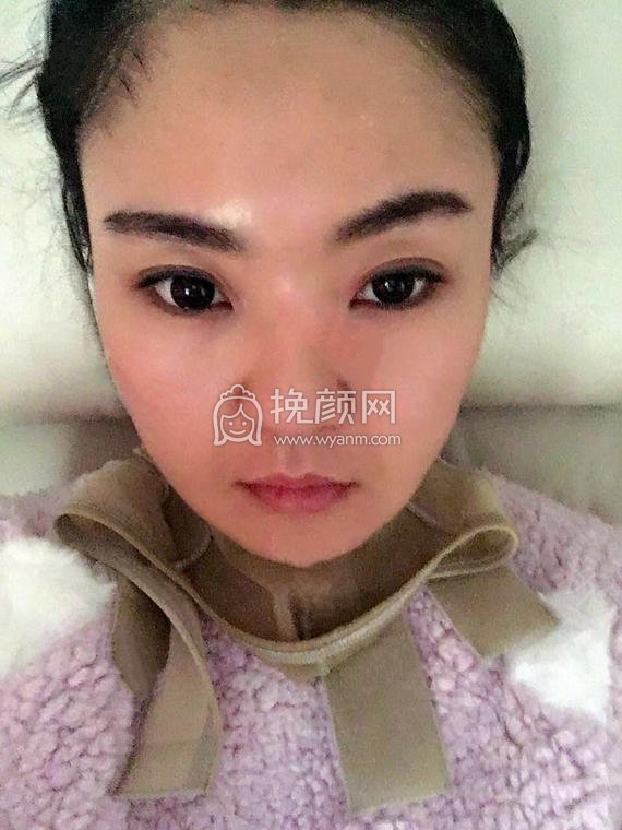 武汉忆美凯德医疗雷文斌面部吸脂案例!分享!
