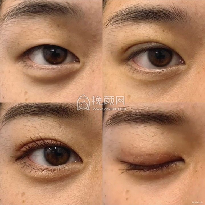 华美紫馨杨继红双眼皮好吗？失败分享?