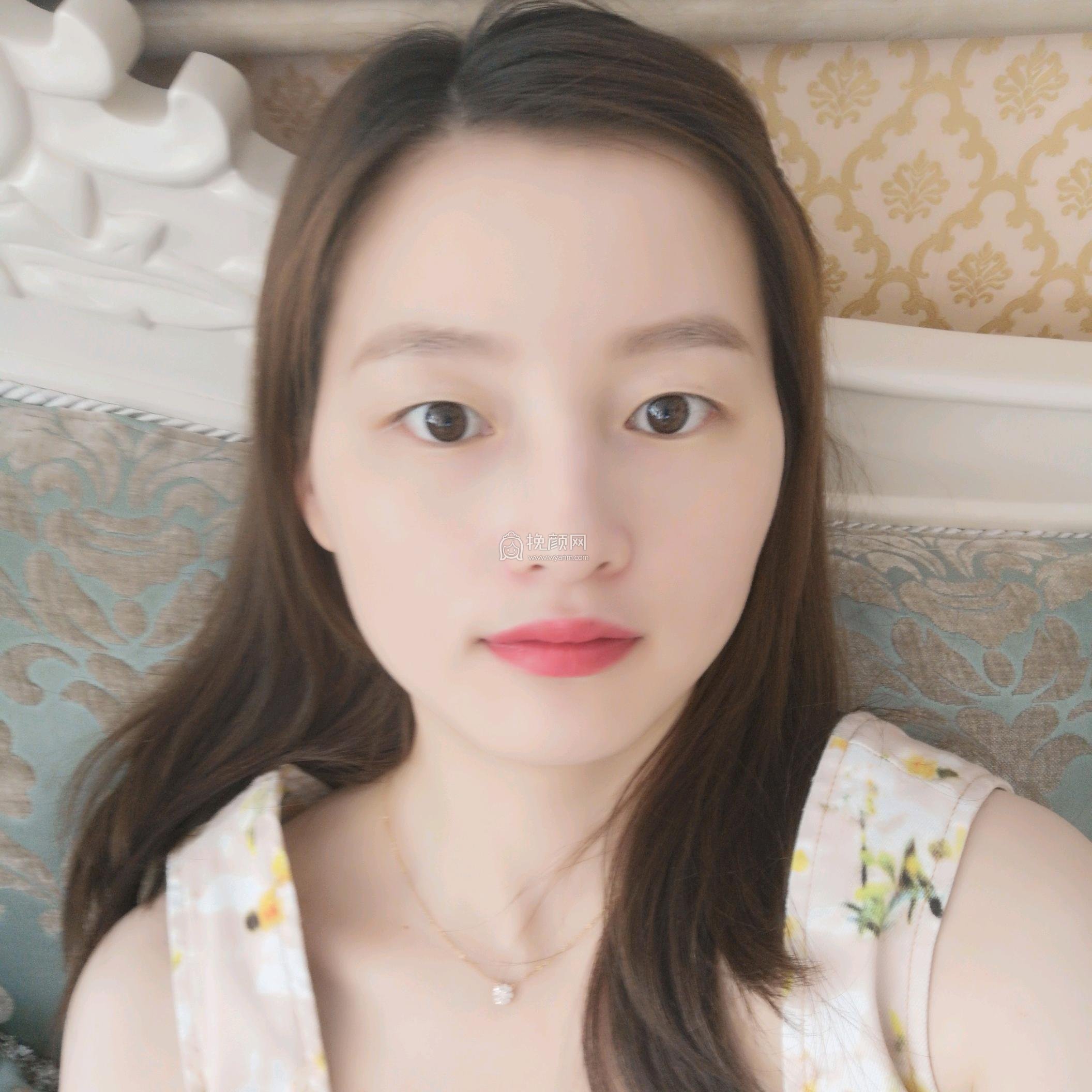 北京亚楠容悦医疗任影任影面部吸脂怎么样?好