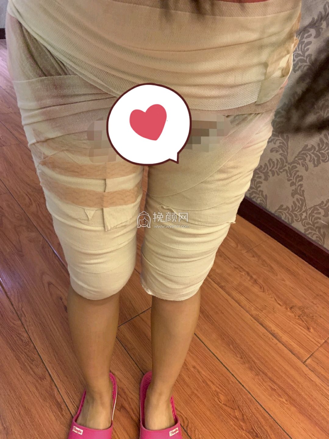 北京达美如艺医疗国海军大腿吸脂好吗?案例