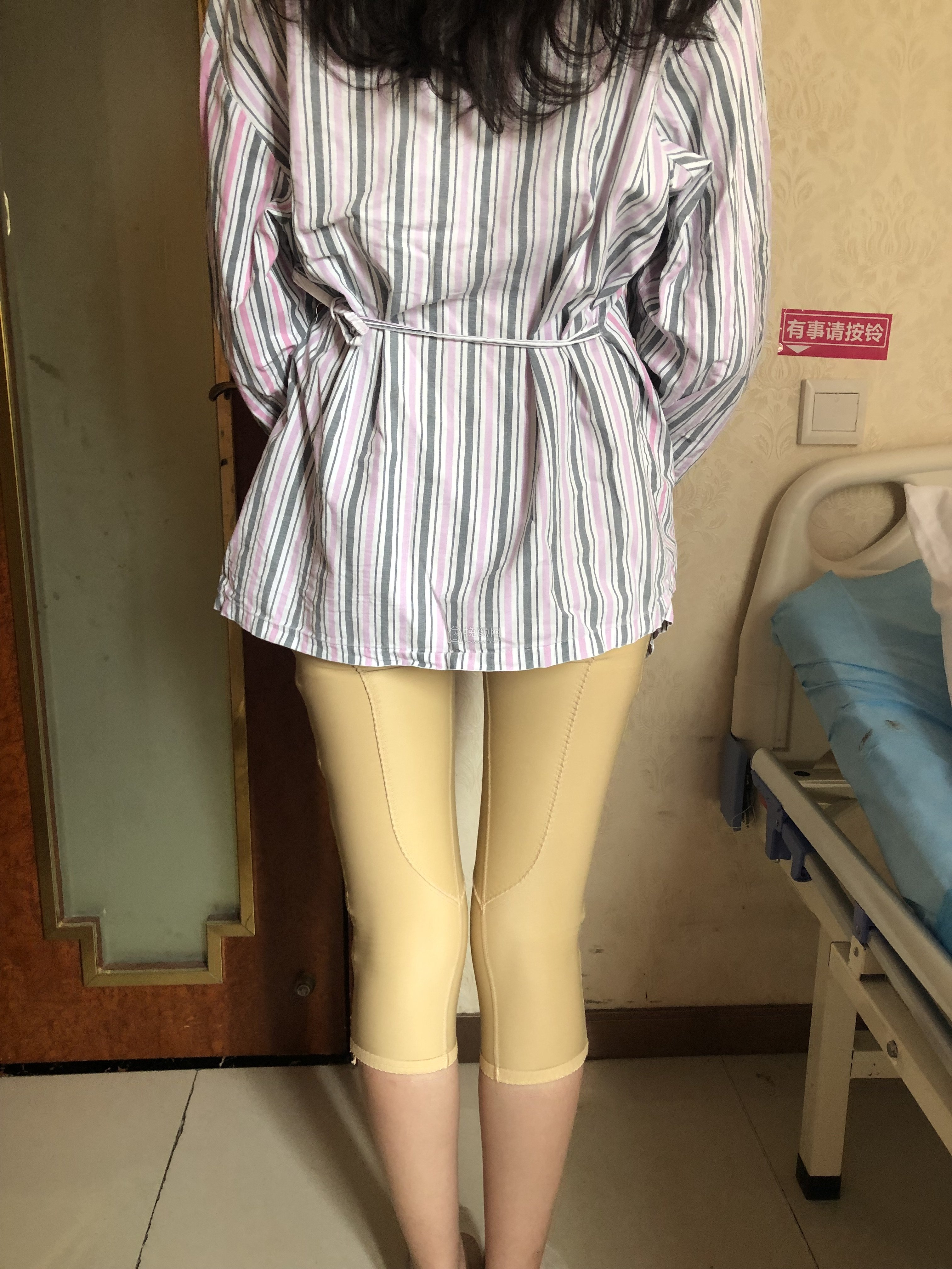 长沙三和医疗大腿吸脂怎么样?真实案例
