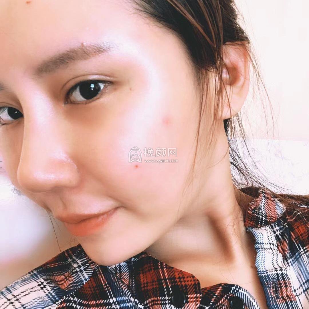 北京蜜邦医疗程旺面部脂肪填充怎么样?案例