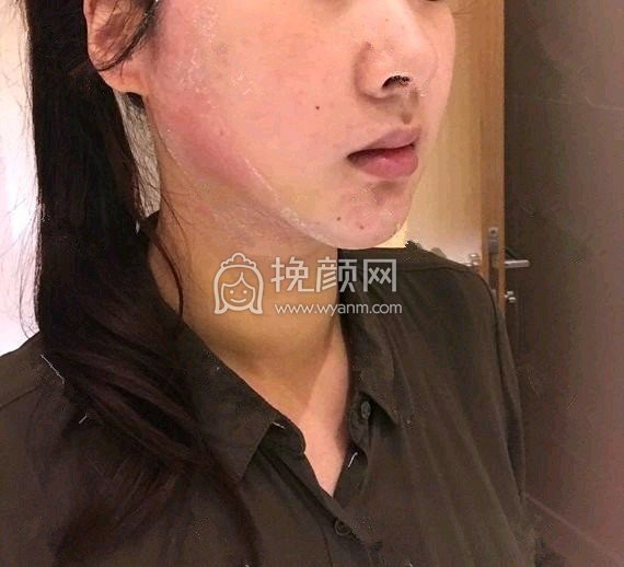 上海薇琳医疗面部吸脂项目做的怎么样?案例提