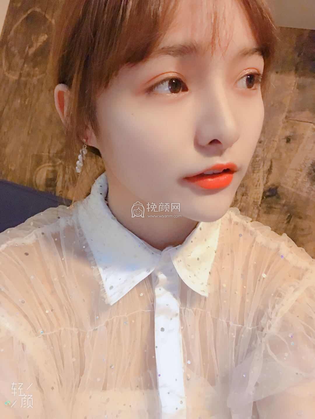 重庆华美整形李任隆鼻好吗?案例附加
