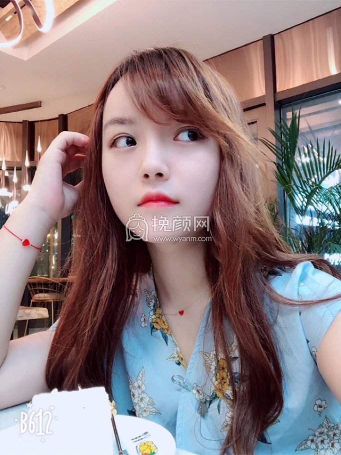 上海南山医院季锦付面部吸脂好吗?案例