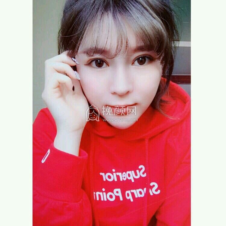 北京雅靓医疗张春彦面部吸脂案例分享!!
