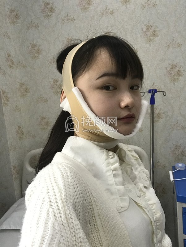 南昌伊丽医疗鲁开贵面部吸脂贵吗?真实案例