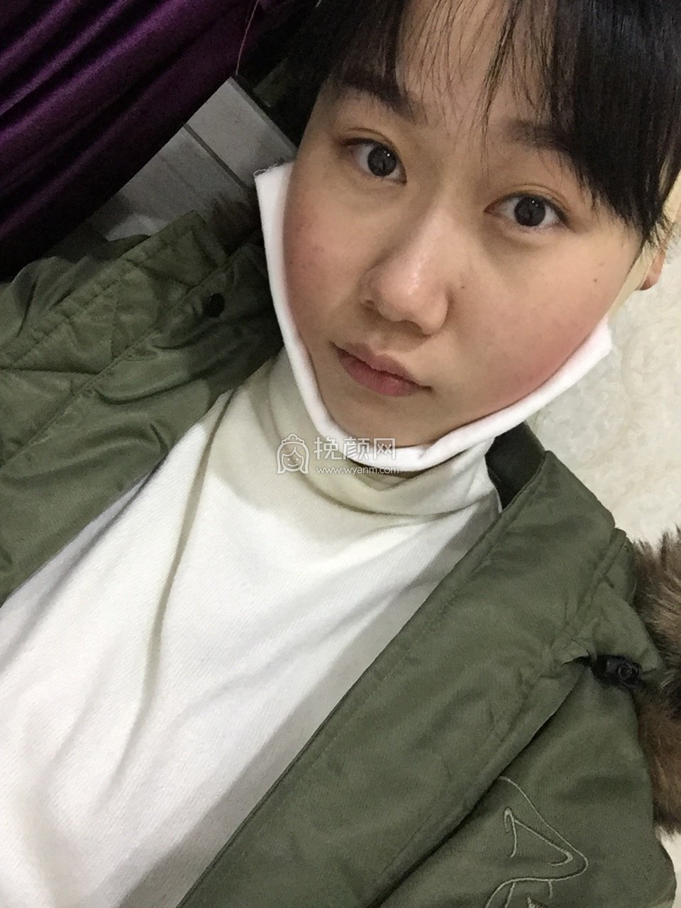 南昌伊丽医疗鲁开贵面部吸脂好吗?案例