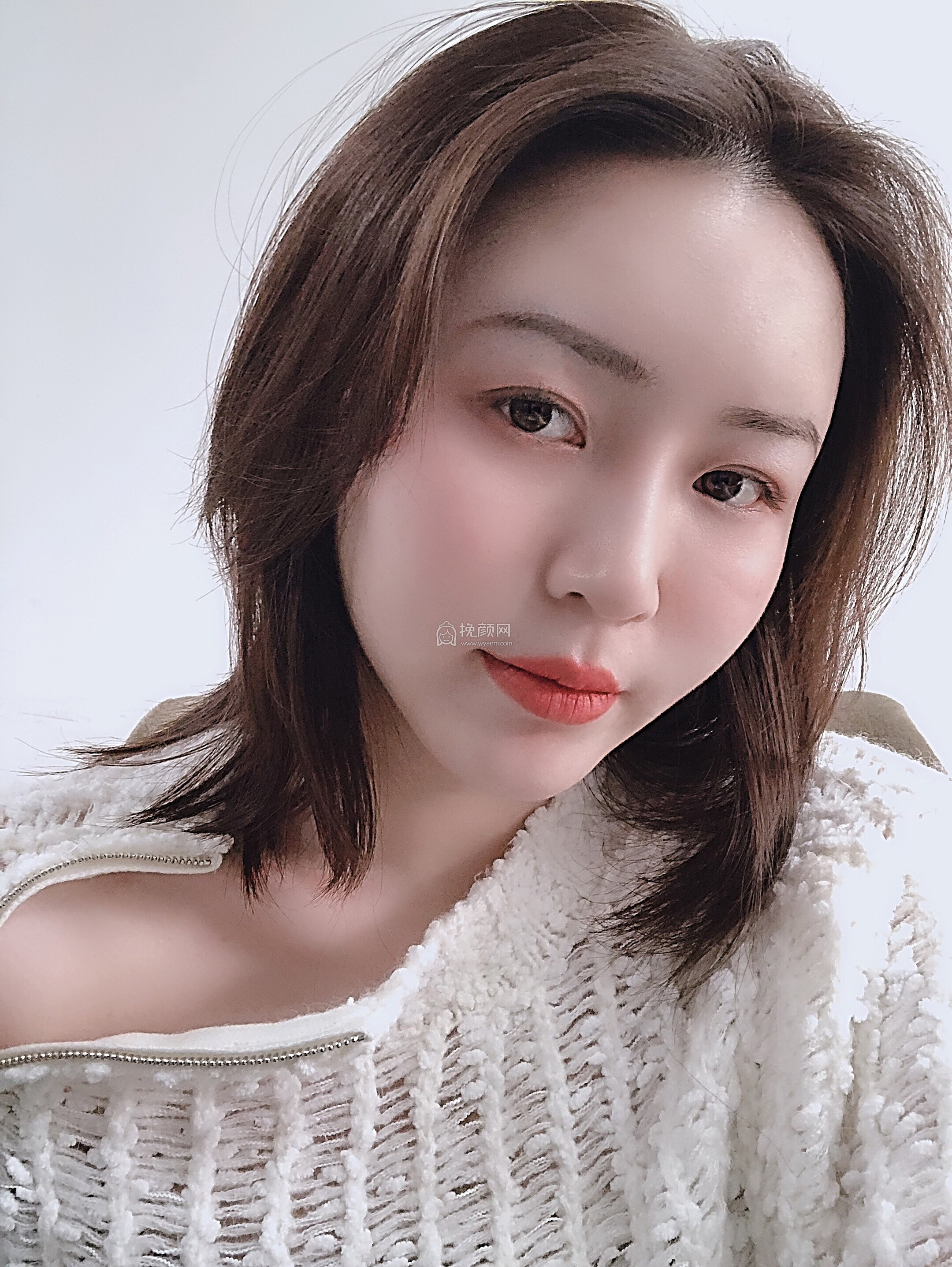 广州今生医疗胡天明面部吸脂案例分享