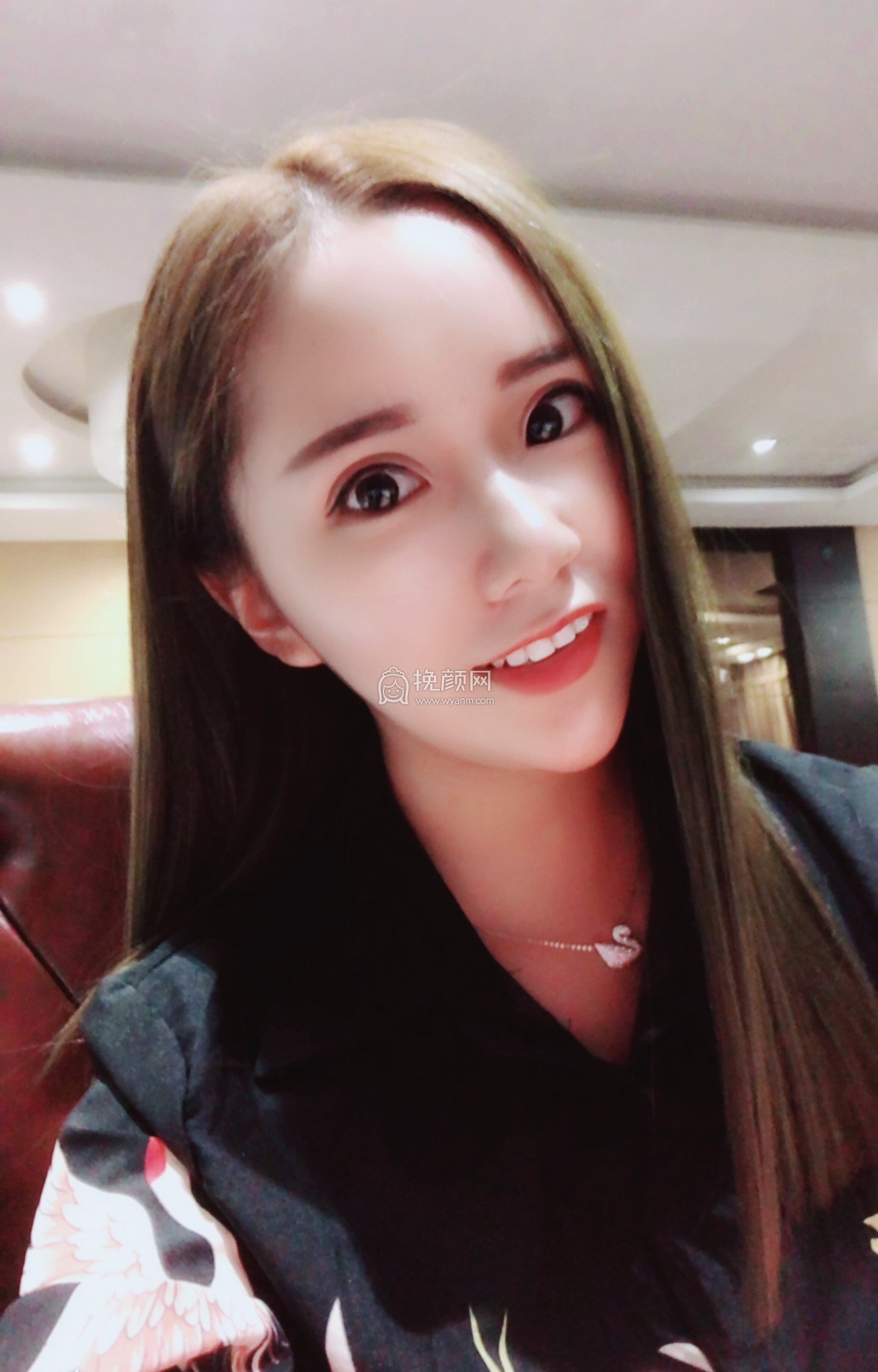 北京艺美医疗巩敏面部吸脂好吗?案例分析
