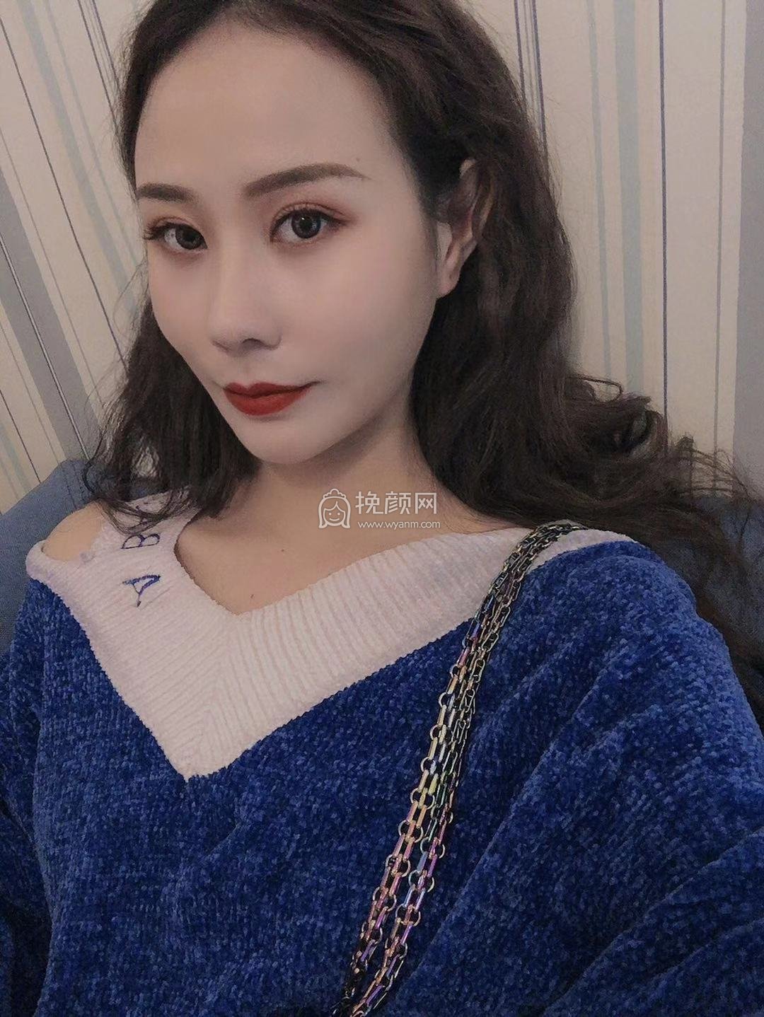 武汉壹加壹医疗付俊俐面部吸脂好吗?案例