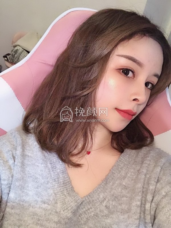 重庆军美医疗曾令宇隆鼻好吗?案例分享