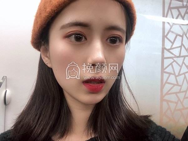杭州美莱医疗李波隆鼻有案例吗?分享
