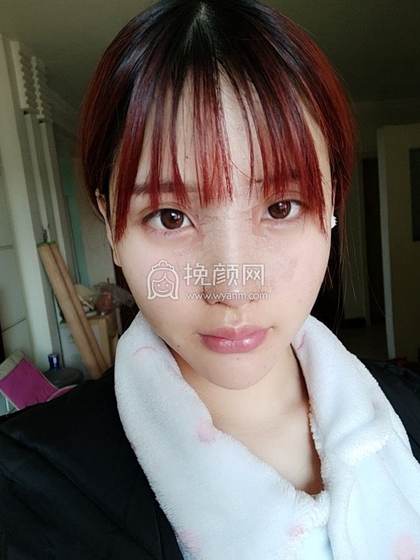 长沙贝美医疗熊宜文隆鼻好吗?案例分享
