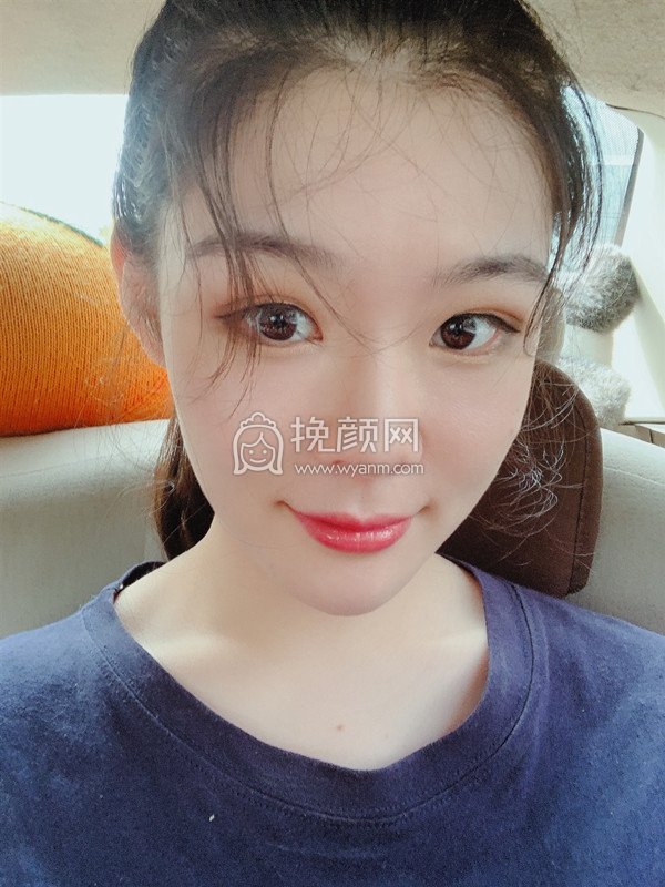 埋线提升案例分享怎么样较佳果?实例