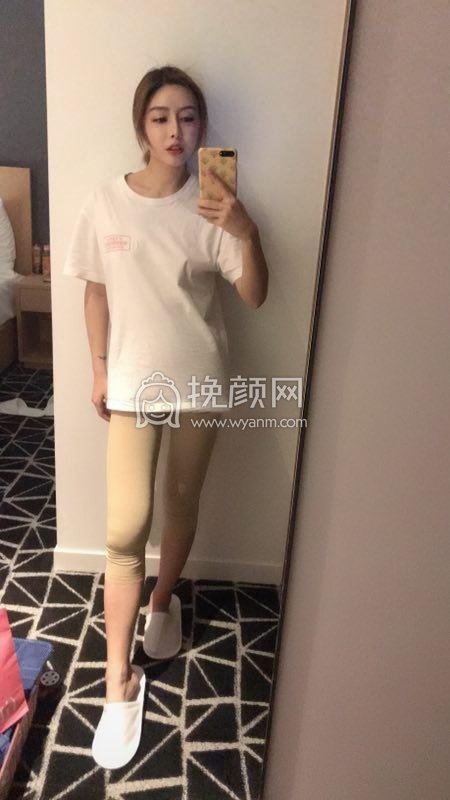 上海市东方刘为廷大腿吸脂好吗?案例分享