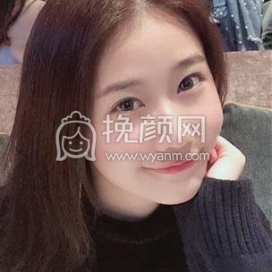 广州可玫尔医疗黄佳诚面部西吸脂好吗?案例分