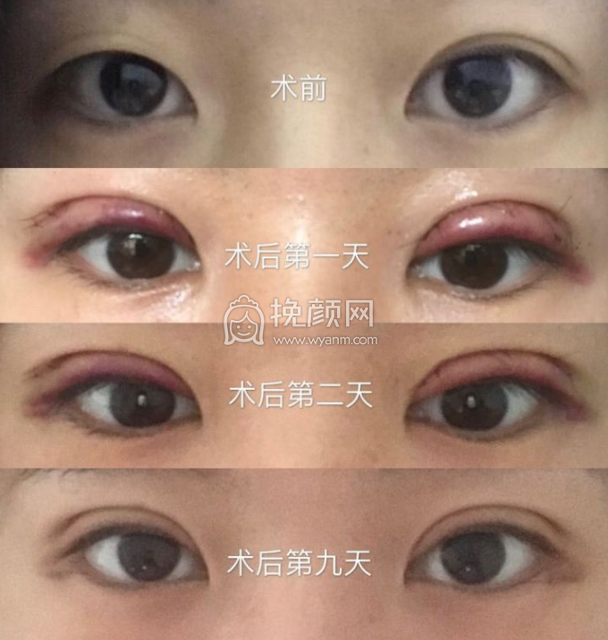 北京姬东硕医生双眼皮做的怎么样?