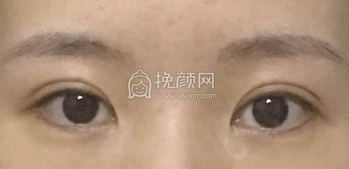 北京姬东硕医生双眼皮做的怎么样?